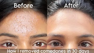 How I removed tiny white bumps from my forehead in 30 days  How to get rid of closed comedones [upl. by Euqinahs]