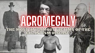 ACROMEGALY The Most InFamous Victims Of The Gigantism Disease  Full Pictures [upl. by Maram]