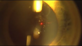 YAG LASER Capsulotomy for Post Cataract Posterior Capsular Fibrosis [upl. by Lillis]