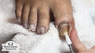 Fix Thick and Discolored Toenails nails satisfying [upl. by Neras]