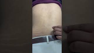 Dryneedling therapy for back pain dryneedling ytshorts backpain physiotheraphy terenaina [upl. by Pitzer801]