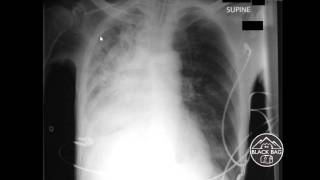 Xray Interpretation  Mucous Plugs [upl. by Enilrahc]