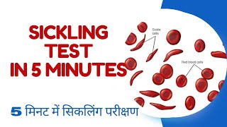 SICKLING TEST IN 5 MINUTES [upl. by Maya]