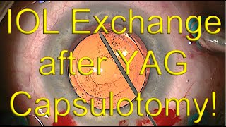 IOL exchange surgery with open capsule after YAG capsulotomy  Dr Simon Chen [upl. by Zebe839]