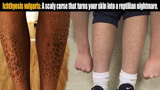 Ichthyosis vulgaris A scaly curse that turns skin into reptilian nightmare [upl. by Meer]