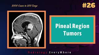 Pineal Region Tumors  Pineoblastoma  Germinoma  Pineocytoma  1000 cases in 100 days  Video 26 [upl. by Lunsford]