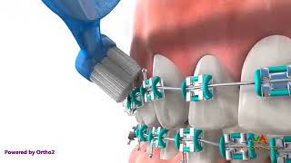 Como escovar os dentes com aparelho ortodôntico  By AVA Orthodontics powered by Ortho 2 [upl. by Drhacir]