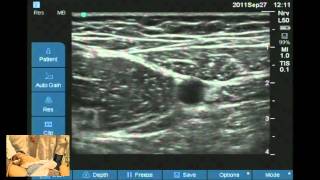 Ultrasound guided obturator and saphenous nerve block workshop [upl. by Llertnom]