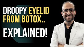 Botox Gone Wrong  Explained [upl. by Gnni]