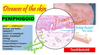 Pemphigoid Causes pathogenesis Types Histopathology Treatment  Pemphigus vs Pemphigoid [upl. by Ahsenahs]