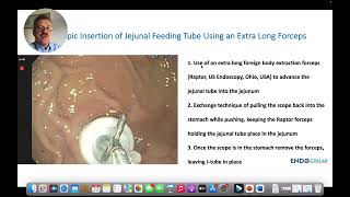 Placing Jejunal Feeding Tube Using the Extra Long Forceps Clip [upl. by Emogene]