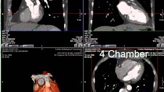 Coronary CT Angiography RCA Stenosis [upl. by Brantley]