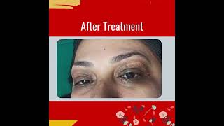 Best xanthelasma treatment in KolkataIndia [upl. by Temhem942]