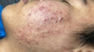 ACNE TREATMENT VU QUYNH MI Acne On Boys Cheek 2024 [upl. by Erena]