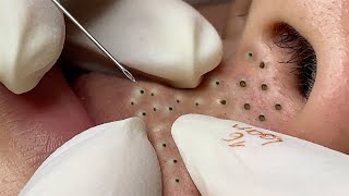 Big Cystic Acne Blackheads Extraction Blackheads amp Milia Whiteheads Removal Pimple Popping  1279 [upl. by Nodgnal180]