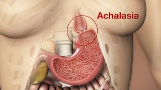 Symptoms of Achalasia amp Clinical Presentation [upl. by Sherer550]