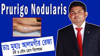 Prurigo Nodularis চিকিৎসা ও সঠিক ব্যবস্থাপনা  ডা আলমগীর রেজা  প্রুরিগো নোডুলারিস চিকিত্সা [upl. by Sephira]