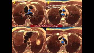 Matching anatomical relations in thoracic cross sections [upl. by Sinnaoi]