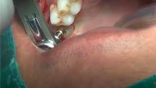 Gingivectomy for emergence profile with diamond bur [upl. by Waly469]