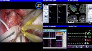 Neurorgsnet Cirugía cavernoma rolándico [upl. by Aianat]