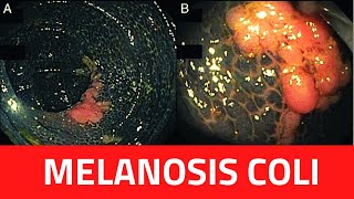 What is Melanosis Coli  Melanosis Coli CausesTreatment LaxativesBiopsyDiagnosis [upl. by Cash]