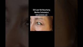 CO2 Fractional Laser Skin Resurfacing for Youthful Fresh Skin skincare sports beauty car [upl. by Iilek]