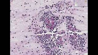 Histopathology Brain Mucormycosis meningoencephalitis [upl. by Laamaj]