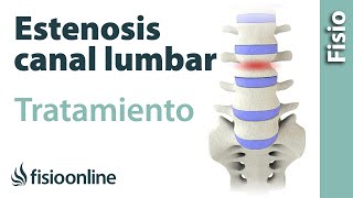 Estenosis de canal lumbar  Causas síntomas y tratamiento [upl. by Nilesoj]