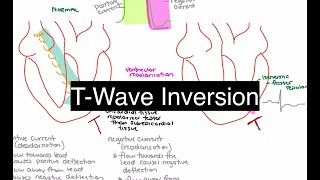 Ischemic TWave Inversion [upl. by Starks]