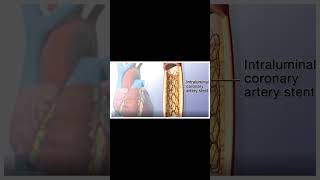 Angioplasty Procedure Animation VideoWhat are the steps of angioplasty [upl. by Sall]