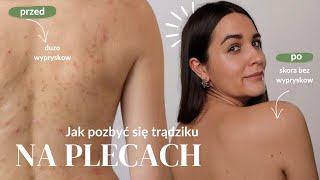 Jak pozbyć się trądziku na plecach 🧖🏼‍♀️ ✨ łatwe i skuteczne sposoby na bacne [upl. by Nylassej]