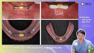 Attachments for Implant Overdentures by Professor Manabu Kanazawa DDS PhD from TMDU [upl. by Nrev]