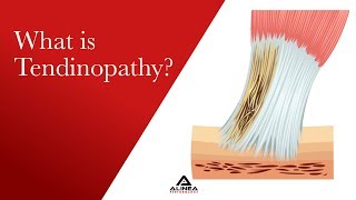 What is Tendinopathy [upl. by Ayidan]