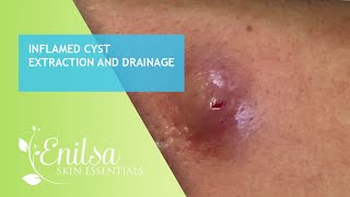 Inflamed Cyst Extraction and Drainage [upl. by Carolynn]