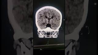 Corpus Callosum Agenesis  Radiology [upl. by Ayal769]