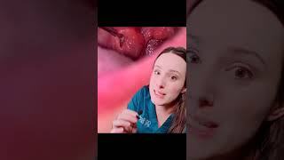 Tonsil stone removal dentist reacts 🤢 [upl. by Mall292]