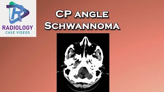 CP angle Schwannoma [upl. by Notnirb]