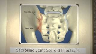 Dr Kornick Riverside Spine Jacksonville 904 3891010 Sacroiliac Joint Steroid Injection [upl. by Lonyer]