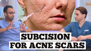 Subcision Acne Scars  Minor Surgery For Acne Scarring  Dr Somji amp Dr Solomon Explain Acne Scars [upl. by Felder]