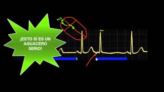 CURSO DE ELECTROCARDIOGRAFIA 47  EXTRASÍSTOLES SUPRAVENTRICULARES [upl. by Ario]