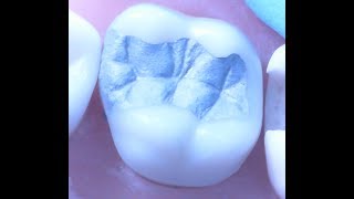 Class II Amalgam Restoration 1  Operative Dentistry [upl. by Nnayllek]