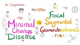 Minimal Change Disease MCD VS Focal Segmental Glomerulosclerosis FSGS  Nephrotic Syndrome [upl. by Aynav982]