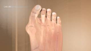 La correction de lhallux valgus et de ses complicationsDr Coillard  Dr Boublil  Dr Grisard [upl. by Sybila]