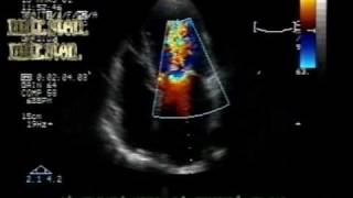 MS different aspectsmitral stenosis with leaflets borders calcification [upl. by Champaigne]