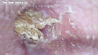 Ear Wax Removal 118 The Earwax Is So Dry And Sticky That It Hurts My Ears  Ear Cleaning ASMR [upl. by Hsirk]