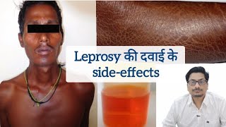 Leprosy की दवाई के sideeffects  Clofazimine  Hansepran  Rifampicin leprosy clofazimine कुष्ट [upl. by Hannahs982]