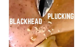 Blackhead plucking tweezer giant holes on skin silent peaceful relaxing satisfying 拔黑头粉刺 巨大毛孔 [upl. by Gothurd]