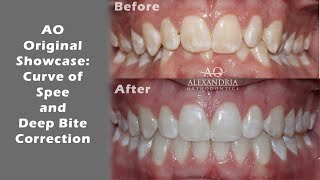 Braces timelapse  Deep Bite progress [upl. by Calley]