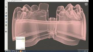 Introral implant scans to printed models with 3shape Model Builder and Meshmixer part 2 [upl. by Llamaj137]