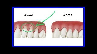 3 remèdes naturels pour réparer les gencives qui se rétractent [upl. by Manbahs660]